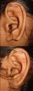 Before After Pictures,Cosmetic surgery,Delhi,ear Lobe Repair,Reconstruction